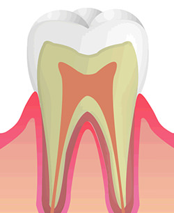 CO（初期のむし歯）