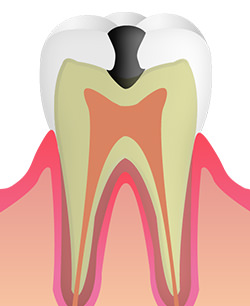 C2（神経手前の象牙質までのむし歯）