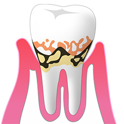 軽度の歯周病