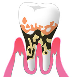 重度の歯周病